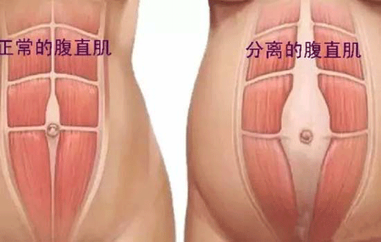 产后恢复加盟中心，产后腹直肌分离怎么办？