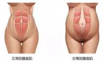 腹直肌分离影响的只是形体美观？那你就大错特错了！