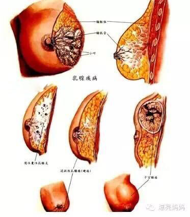 乳房肿块是怎么回事