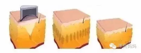 【漂亮妈妈科普篇】有一种瘦叫我是你的热立塑！