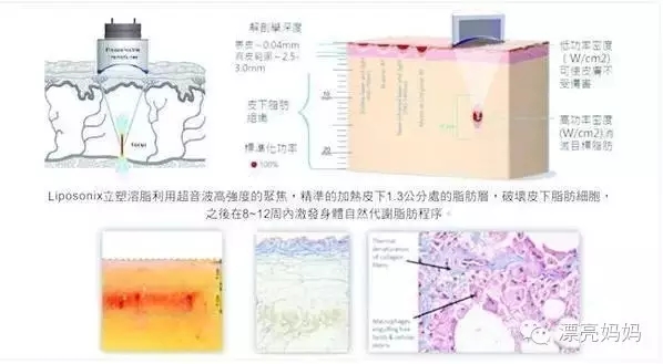【漂亮妈妈科普篇】有一种瘦叫我是你的热立塑！