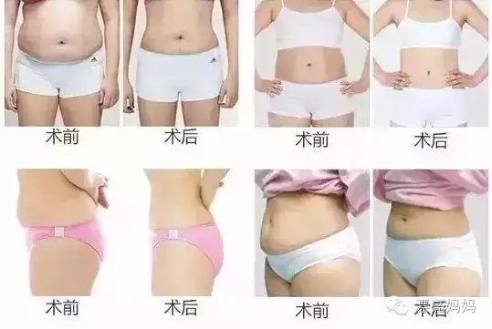 【漂亮妈妈科普篇】有一种瘦叫我是你的热立塑！
