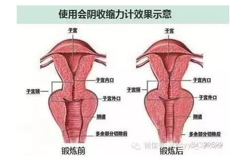 产后盆底肌修复，产后42天，你检测了吗?