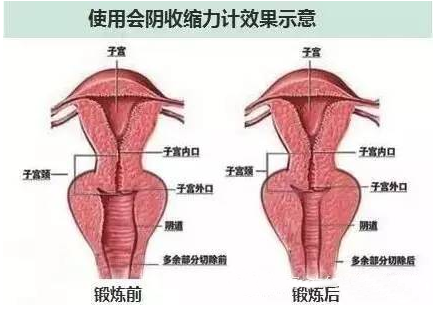 产后漏尿，别全冤枉顺产！罪魁祸首盆底肌受损