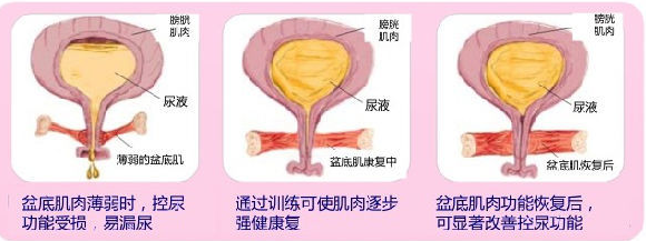 女性产后憋不住尿、漏尿是怎么回事？盆底肌受损了吗？