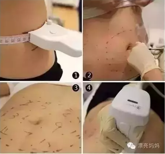 产后肚子收不回去的真凶！腹直肌分离还能修复吗？