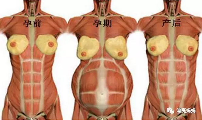 产后肚子收不回去的真凶！腹直肌分离还能修复吗？